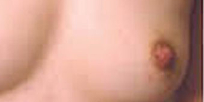 乳頭內(nèi)陷矯正術后