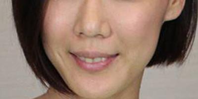 伊膚泉療程套組術(shù)后