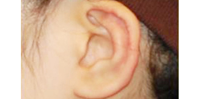 招風(fēng)耳矯正術(shù)后