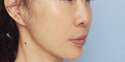 熱瑪吉術(shù)后