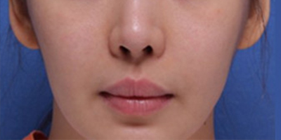 人中縮短術(shù)術(shù)前