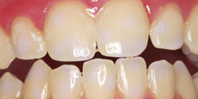 皓齒美白術(shù)前