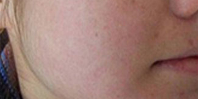 射頻美膚術(shù)后