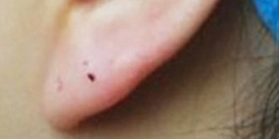 自體脂肪豐耳垂術(shù)后