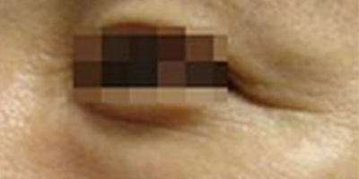 注射去魚(yú)尾紋術(shù)后