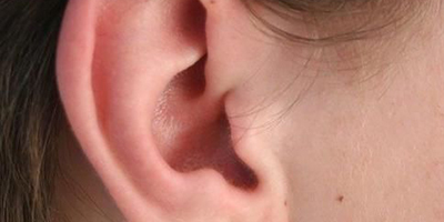 副耳去除術(shù)術(shù)后