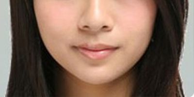 自體脂肪豐面頰術后