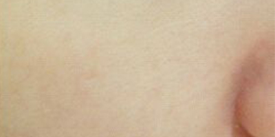 DPL美膚術(shù)后