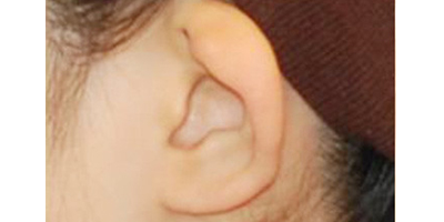 招風(fēng)耳矯正術(shù)前