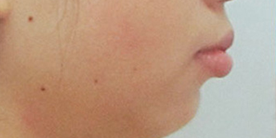 隱形矯正術(shù)前