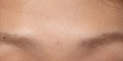 自體脂肪豐額頭術(shù)前