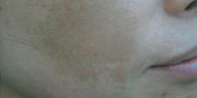 鐳射凈膚術(shù)前