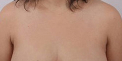 手術(shù)去副乳術(shù)后