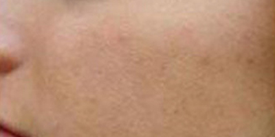 脂肪填充失敗修復(fù)術(shù)后