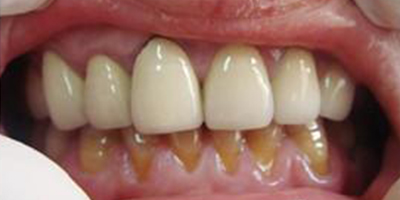 合金烤瓷牙術(shù)前