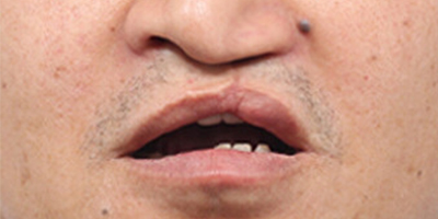 唇腭裂手術(shù)術(shù)前