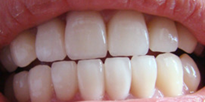 自鎖托槽矯正術(shù)后