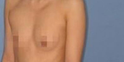 自體脂肪隆胸術(shù)前