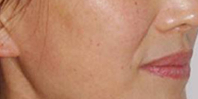 自體脂肪去法令紋術前