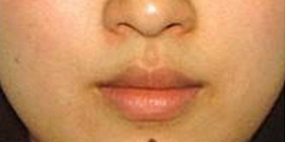 美白注射術(shù)前