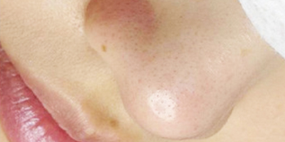 超微小氣泡術后