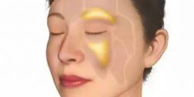 自體脂肪存儲術后