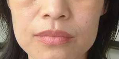 經(jīng)絡(luò)凈排術(shù)前