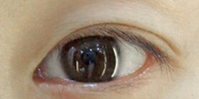 半永久美瞳線術(shù)前