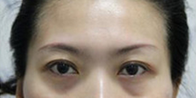 自體脂肪豐太陽穴術前