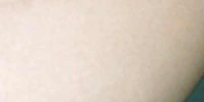 無創(chuàng)疤痕修復術后