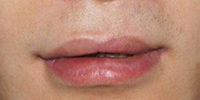 唇部修復(fù)術(shù)后