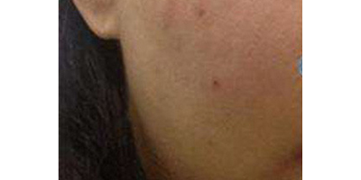 無針?biāo)庑g(shù)前