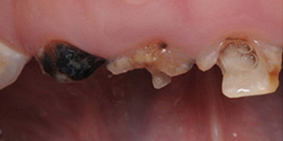 顯微鏡根管治療術(shù)前