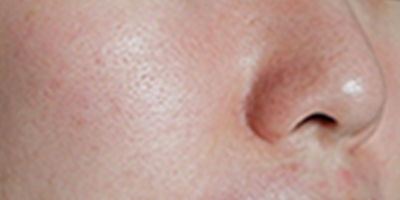 射頻微針術(shù)前