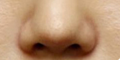 鼻部修復術(shù)后