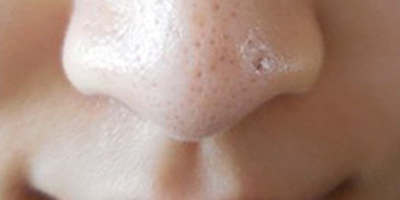 彩光嫩膚術(shù)前