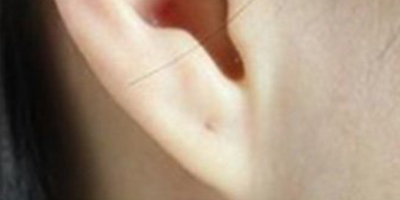 玻尿酸豐耳垂術前