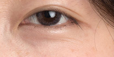 OPT美膚術(shù)前