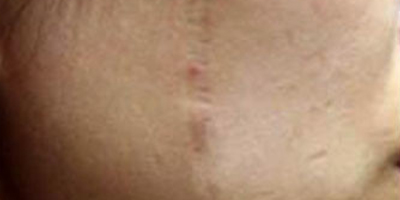 激光祛疤術(shù)前