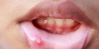 口腔潰瘍術(shù)前