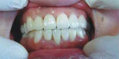 貴金屬烤瓷牙術(shù)后