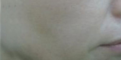 鐳射凈膚術(shù)后