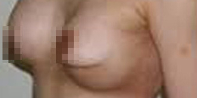 隆胸修復(fù)術(shù)前