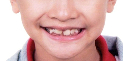 兒童早期干預矯治—mrc肌功能矯治術前