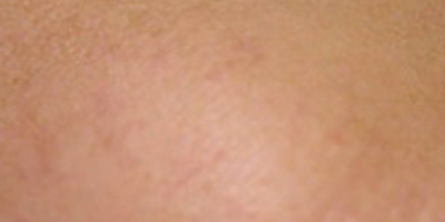 黃金微針術(shù)后