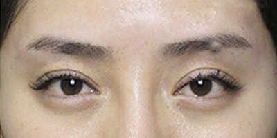 自體脂肪豐眉弓術(shù)后