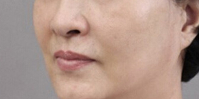 青春解碼儀美膚術(shù)后