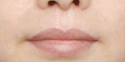 洗唇線術(shù)后