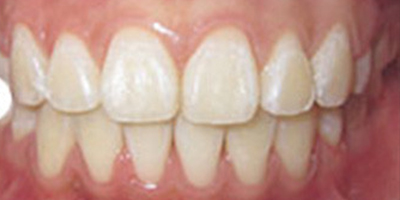 金屬托槽矯正術(shù)后