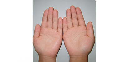 注射治療多汗術(shù)后